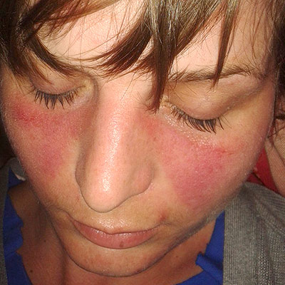 Skin inflammation is a common symptom in people with lupus and many get this distinctive butterfly-shaped rash on their face. : Wikimedia Commons: Doktorinternet CC BY-SA 4.0